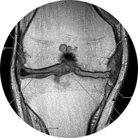 MRI knie boven 50 jaar weinig zinvol